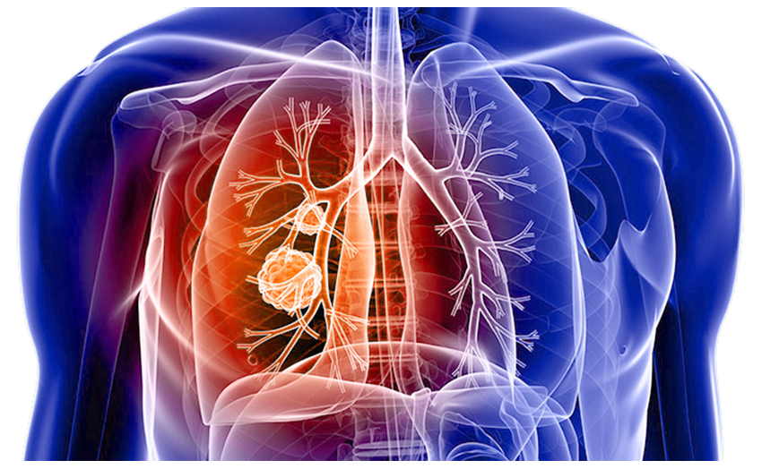 افزایش فاکتور توزیع دامنه حجم گلبول قرمز (RDW) و ارتباط آن با سرطان ریه